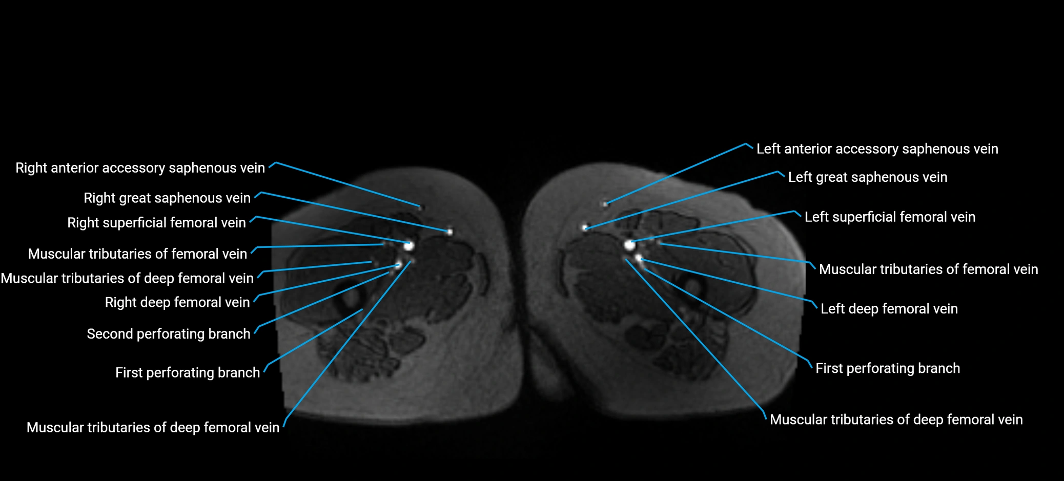 MRV abdomen pelvis & lower limb axial cross sectional anatomy labelled MRI image 223 (1).webp